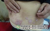 [济南银屑病a专治]寻常型牛皮癣怎么治疗效果好?