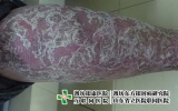 脓疱型银屑病介绍：症状、危害与治疗