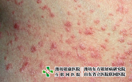 滴状银屑病 2