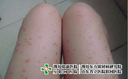 济南治银屑病好医院:银屑病打生物制剂影响生育吗