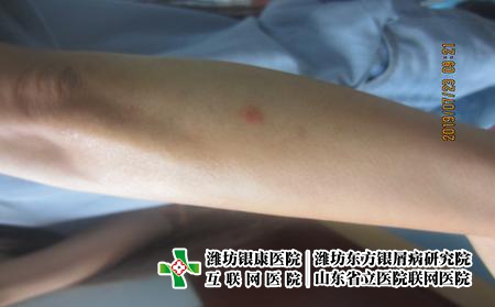 济南牛皮癣药物治疗注意问题，牛皮癣怎么用药