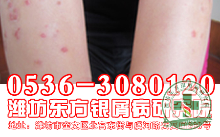 晒晒那些年困扰我们的银屑病