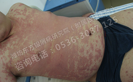 牛皮癣禁忌吃什么