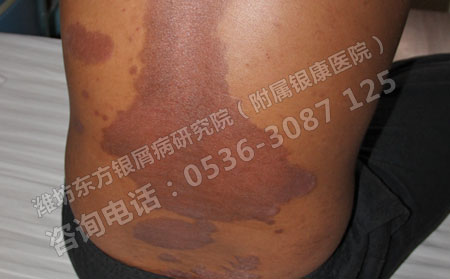 济南银屑病患者该怎样预防病情的复发