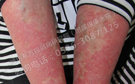 女性朋友如何预防牛皮癣的发生