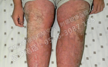 济南哪里看牛皮癣效果比较可以