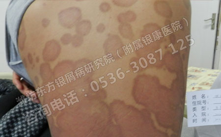 济南哪个医院能治可以银屑病