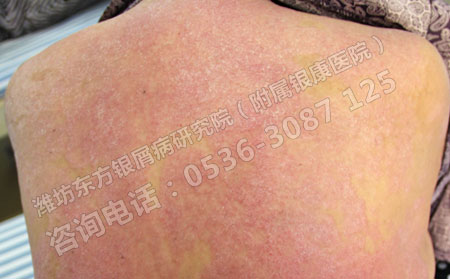 春季怎么护理寻常型牛皮癣呢