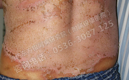 银屑病发生在背部的时候该怎么治疗