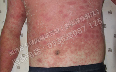 病情恶化为红皮型银屑病该怎么办