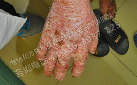 患上关节型牛皮癣有什么办法治可以吗