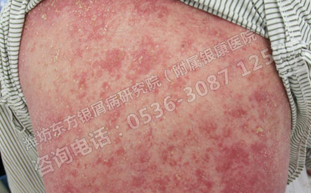 得了脓疱型牛皮癣还能治可以吗