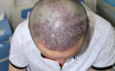 济南哪个医院可以治疗头部牛皮癣