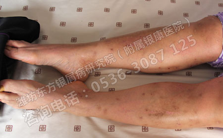 想降低银屑病的危害就要选对治疗方法