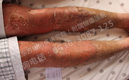 女性银屑病患者使用化妆品会不会影响银屑病的病情？