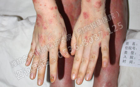 心理治疗对于牛皮癣患者同样重要