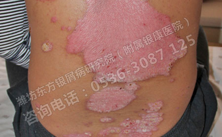 红皮型银屑病治疗效果可以治的方法