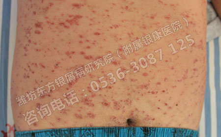 牛皮癣患者夏季吃点什么可以？