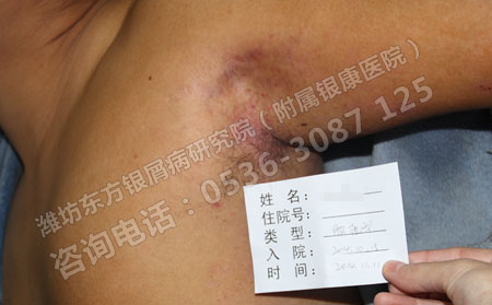济南银屑病医生分析：为什么用电脑会加大患有牛皮癣的几率