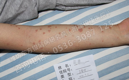 父母亲都是牛皮癣患者，孩子就一定会遗传上牛皮癣吗？