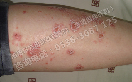 夏季牛皮癣出现的原因你知道吗