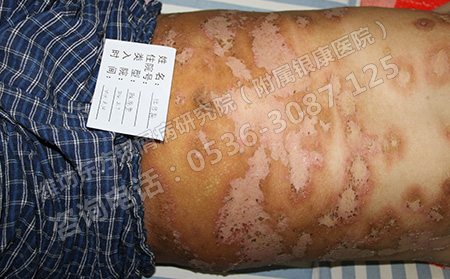 牛皮癣是有什么因素造成的