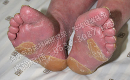 生活中哪些因素导致了牛皮癣的发病