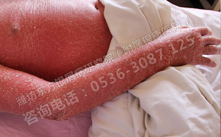 牛皮癣患者应该怎样缓解生活中的压力