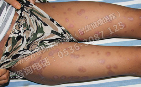 儿童牛皮癣怎样护理才有助于病情恢复
