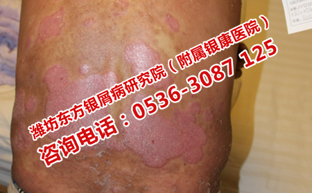 牛皮癣检查需要化多少钱呢