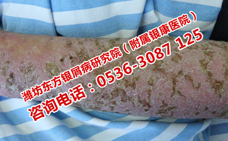 夏季牛皮癣患者应该怎样饮食