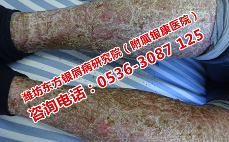 济南哪家医院治疗牛皮癣专业
