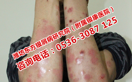 牛皮癣患者吃什么有利于病情恢复