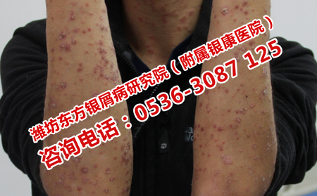关节型牛皮癣有哪些特征