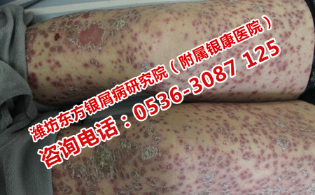 治可以牛皮癣得花多少钱
