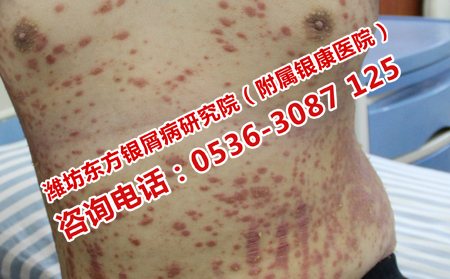夏天牛皮癣出现的原因是什么