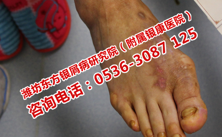牛皮癣患者能不能吃牡蛎？