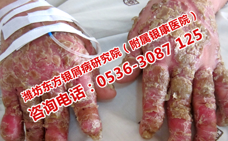 关节型牛皮癣治疗的要点