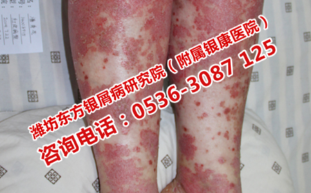 牛皮癣患者日常应该怎样运动？