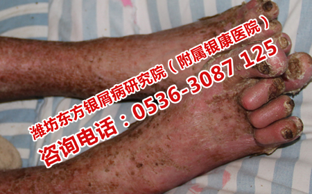 怎样做可以防止牛皮癣的复发