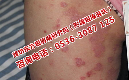 得了脓疱型牛皮癣应该去哪儿治疗