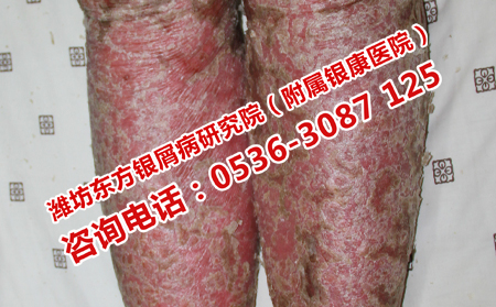 得了牛皮癣应该怎样治疗