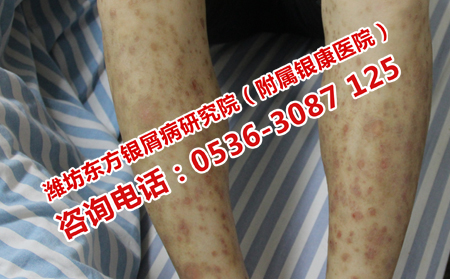 牛皮癣患者在日常应该怎样护理