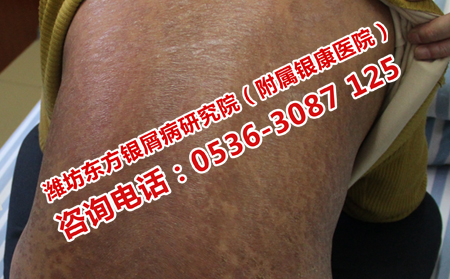 带来牛皮癣应该去哪儿治疗