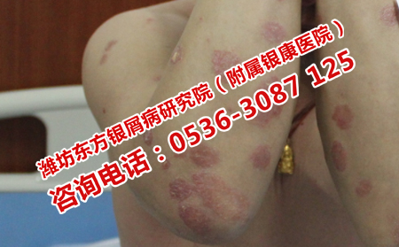 牛皮癣的并发症是什么