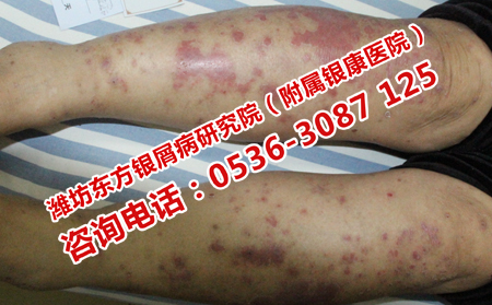 牛皮癣怎样治疗比较可以