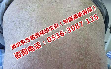 怎样治疗牛皮癣较有效