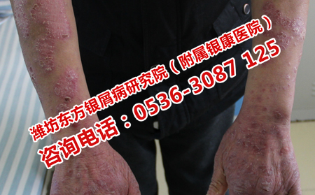 牛皮癣的治疗应该注意什么问题