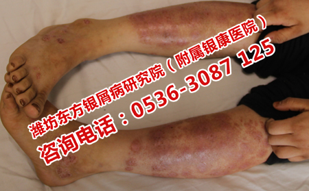 得了牛皮癣应该去哪儿治疗