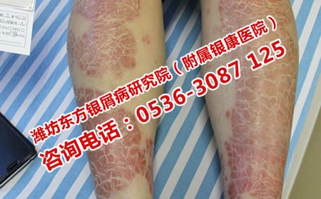 牛皮癣患者在日常吃点什比较可以